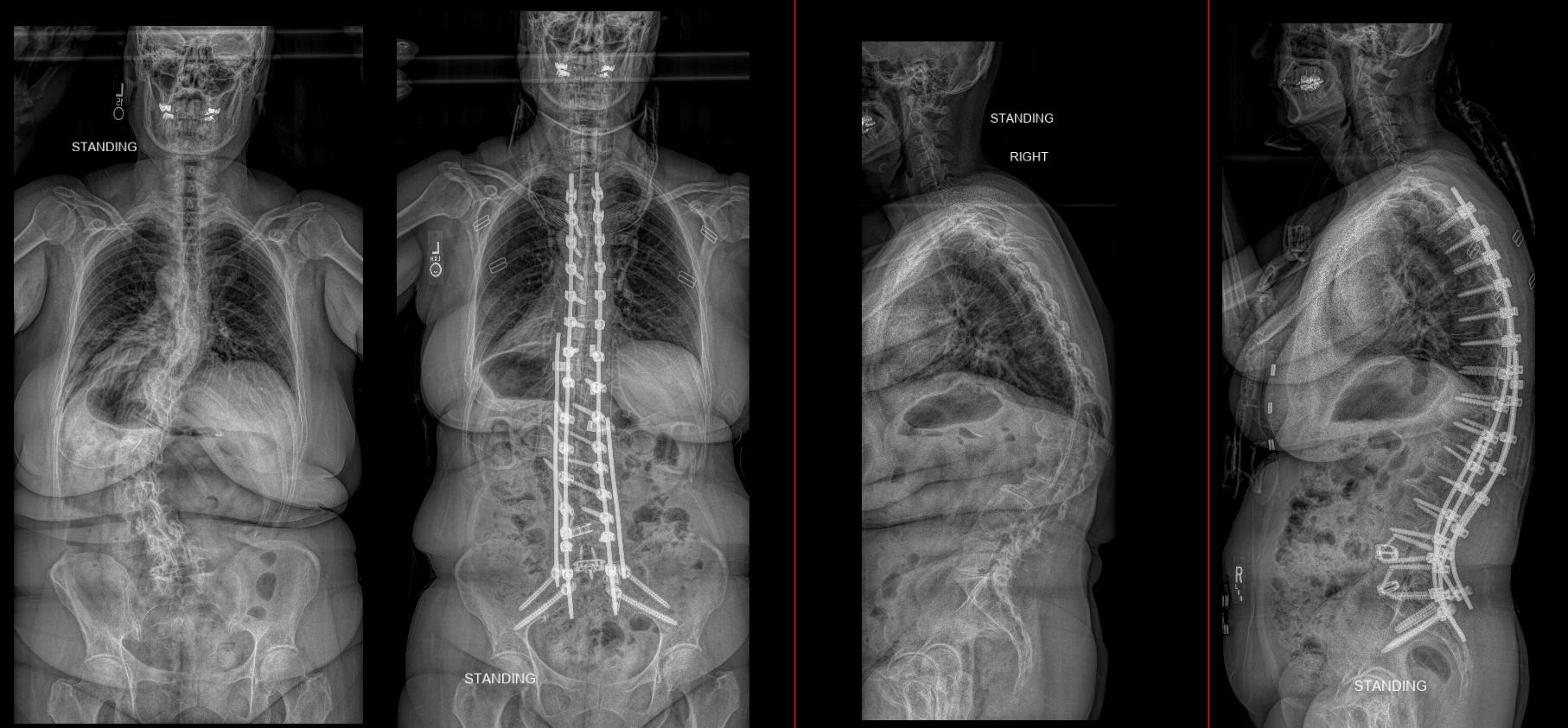 Standing AP and lateral films before and after T2–pelvis reconstruction