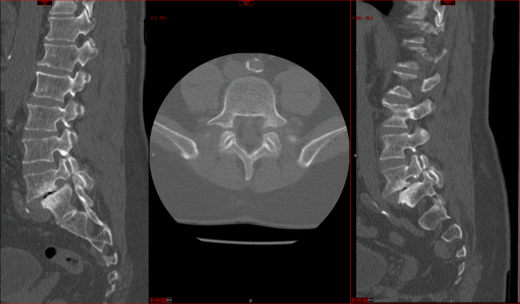 L5–S1 spondylolisthesis, CT