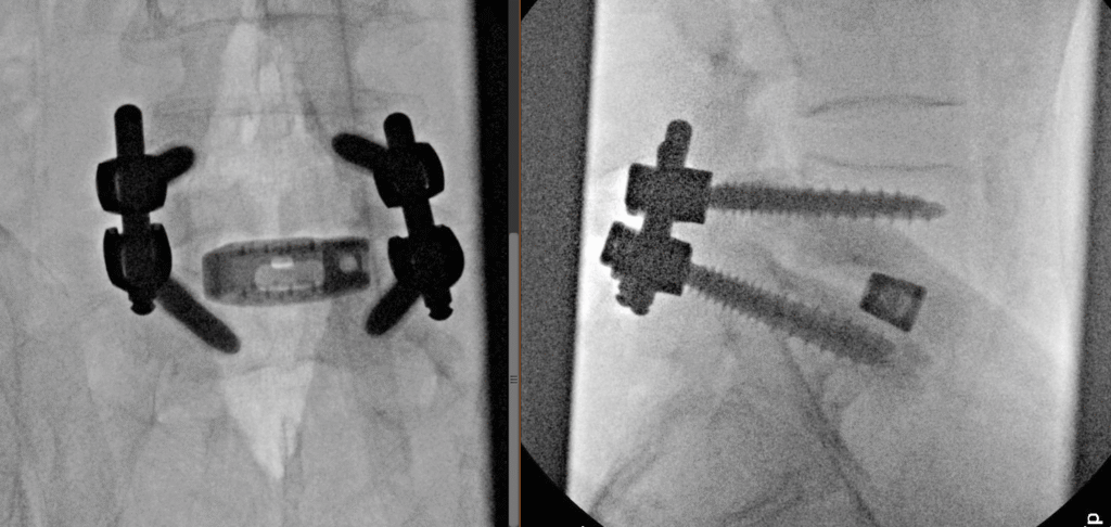 L5–S1 TLIF, intraoperative