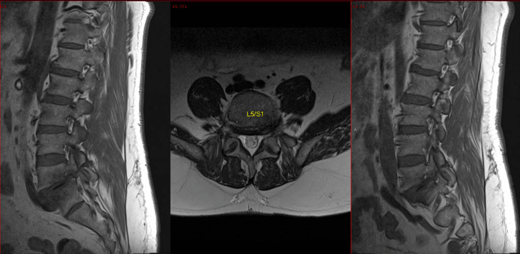 L5–S1 spondylolisthesis, MRI