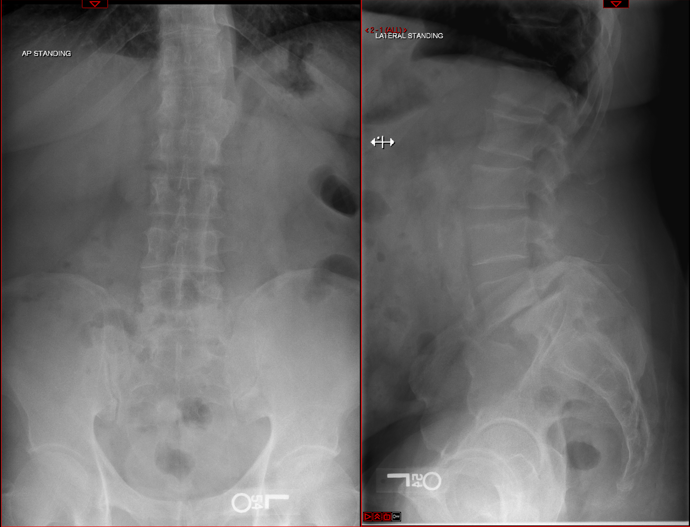 L5–S1 spondylolisthesis